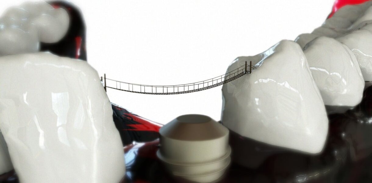 Implanturi dentare în București