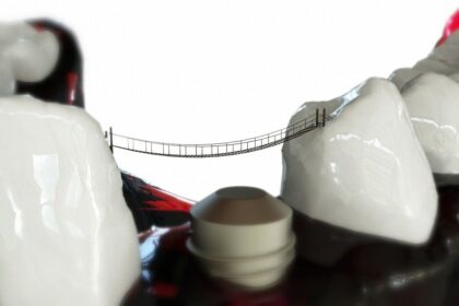 Implanturi dentare în București