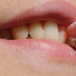 tratamentul ortodontic cu implant dentar
